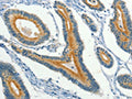 The image on the left is immunohistochemistry of paraffin-embedded Human colon cancer tissue using CSB-PA034861(KLC1 Antibody) at dilution 1/40, on the right is treated with fusion protein. (Original magnification: ×200)