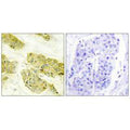 Immunohistochemistry analysis of paraffin-embedded human breast carcinoma tissue using Collagen V α3 antibody.