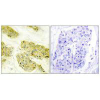 Immunohistochemistry analysis of paraffin-embedded human breast carcinoma tissue using Collagen V α3 antibody.