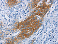 The image on the left is immunohistochemistry of paraffin-embedded Human esophagus cancer tissue using CSB-PA035070(CCR9 Antibody) at dilution 1/60, on the right is treated with fusion protein. (Original magnification: ×200)