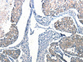 The image on the left is immunohistochemistry of paraffin-embedded Human breast cancer tissue using CSB-PA035138(Ccl6 Antibody) at dilution 1/50, on the right is treated with synthetic peptide. (Original magnification: ×200)