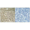 Immunohistochemistry analysis of paraffin-embedded human breast carcinoma tissue using RPL40 antibody.