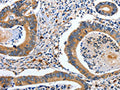 The image on the left is immunohistochemistry of paraffin-embedded Human colon cancer tissue using CSB-PA035369(EFNB2 Antibody) at dilution 1/80, on the right is treated with fusion protein. (Original magnification: ×200)