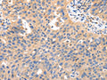 The image on the left is immunohistochemistry of paraffin-embedded Human ovarian cancer tissue using CSB-PA036177(IRS2 Antibody) at dilution 1/50, on the right is treated with synthetic peptide. (Original magnification: ×200)