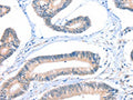 The image on the left is immunohistochemistry of paraffin-embedded Human colon cancer tissue using CSB-PA036665(FHL5 Antibody) at dilution 1/20, on the right is treated with fusion protein. (Original magnification: ×200)