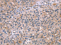 The image on the left is immunohistochemistry of paraffin-embedded Human lung cancer tissue using CSB-PA037845(MAPK3 Antibody) at dilution 1/15, on the right is treated with synthetic peptide. (Original magnification: ×200)