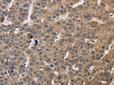 The image on the left is immunohistochemistry of paraffin-embedded Human liver cancer tissue using CSB-PA037904(SDCCAG3 Antibody) at dilution 1/30, on the right is treated with fusion protein. (Original magnification: ×200)
