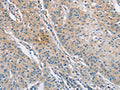 The image on the left is immunohistochemistry of paraffin-embedded Human gastic cancer tissue using CSB-PA037961(SH3GLB1 Antibody) at dilution 1/30, on the right is treated with fusion protein. (Original magnification: ×200)