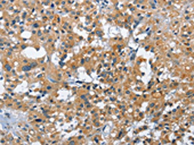 The image on the left is immunohistochemistry of paraffin-embedded Human thyroid cancer tissue using CSB-PA038092(ATF4 Antibody) at dilution 1/40, on the right is treated with fusion protein. (Original magnification: ×200)
