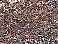 The image is immunohistochemistry of paraffin-embedded Human tonsil cancer tissue using CSB-PA038144(ADRB1 Antibody) at dilution 1/25. (Original magnification: ×200)