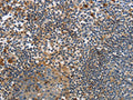 The image on the left is immunohistochemistry of paraffin-embedded Human tonsil tissue using CSB-PA038167(PAK4 Antibody) at dilution 1/20, on the right is treated with fusion protein. (Original magnification: ×200)