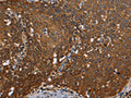 The image on the left is immunohistochemistry of paraffin-embedded Human cervical cancer tissue using CSB-PA038229(REL Antibody) at dilution 1/50, on the right is treated with fusion protein. (Original magnification: ×200)