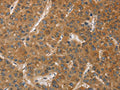 The image on the left is immunohistochemistry of paraffin-embedded Human liver cancer tissue using CSB-PA038642(DCTN1 Antibody) at dilution 1/60, on the right is treated with fusion protein. (Original magnification: ×200)