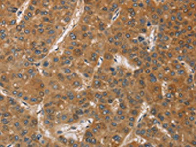 The image on the left is immunohistochemistry of paraffin-embedded Human liver cancer tissue using CSB-PA038642(DCTN1 Antibody) at dilution 1/60, on the right is treated with fusion protein. (Original magnification: ×200)