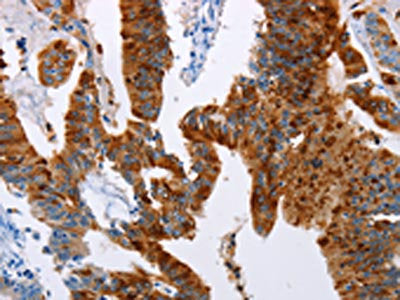 The image on the left is immunohistochemistry of paraffin-embedded Human colon cancer tissue using CSB-PA038921(TFF3 Antibody) at dilution 1/50, on the right is treated with fusion protein. (Original magnification: ×200)