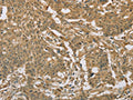 The image on the left is immunohistochemistry of paraffin-embedded Human gastic cancer tissue using CSB-PA039162(EIF6 Antibody) at dilution 1/20, on the right is treated with fusion protein. (Original magnification: ×200)