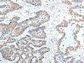 The image on the left is immunohistochemistry of paraffin-embedded Human thyroid cancer tissue using CSB-PA039195(ADAM7 Antibody) at dilution 1/20, on the right is treated with fusion protein. (Original magnification: ×200)