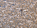 The image on the left is immunohistochemistry of paraffin-embedded Human liver cancer tissue using CSB-PA039309(EDA Antibody) at dilution 1/30, on the right is treated with fusion protein. (Original magnification: ×200)