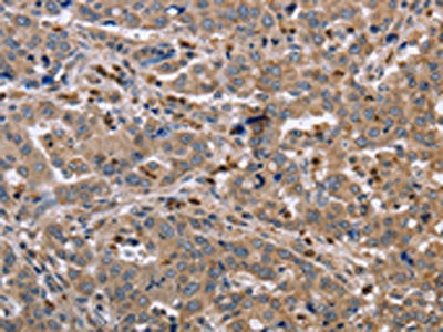 The image on the left is immunohistochemistry of paraffin-embedded Human liver cancer tissue using CSB-PA039309(EDA Antibody) at dilution 1/30, on the right is treated with fusion protein. (Original magnification: ×200)