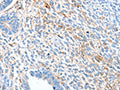The image on the left is immunohistochemistry of paraffin-embedded Human ovarian cancer tissue using CSB-PA039662(ALDH1A2 Antibody) at dilution 1/60, on the right is treated with synthetic peptide. (Original magnification: ×200)