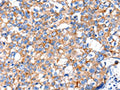 The image on the left is immunohistochemistry of paraffin-embedded Human breast cancer tissue using CSB-PA039843(KLK15 Antibody) at dilution 1/15, on the right is treated with fusion protein. (Original magnification: ×200)