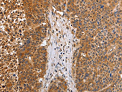 The image on the left is immunohistochemistry of paraffin-embedded Human liver cancer tissue using CSB-PA040512(EGLN3 Antibody) at dilution 1/30, on the right is treated with fusion protein. (Original magnification: ×200)