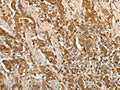 The image on the left is immunohistochemistry of paraffin-embedded Human gastic cancer tissue using CSB-PA040718(F3 Antibody) at dilution 1/25, on the right is treated with fusion protein. (Original magnification: ×200)