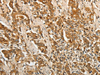 The image on the left is immunohistochemistry of paraffin-embedded Human gastic cancer tissue using CSB-PA040718(F3 Antibody) at dilution 1/25, on the right is treated with fusion protein. (Original magnification: ×200)