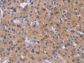 The image on the left is immunohistochemistry of paraffin-embedded Human liver cancer tissue using CSB-PA040869(DVL2 Antibody) at dilution 1/20, on the right is treated with synthetic peptide. (Original magnification: ×200)