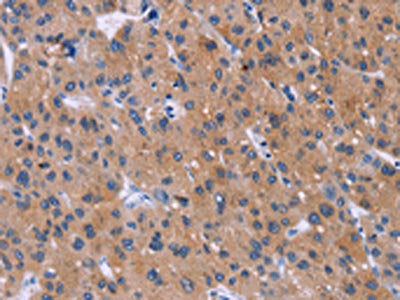 The image on the left is immunohistochemistry of paraffin-embedded Human liver cancer tissue using CSB-PA040869(DVL2 Antibody) at dilution 1/20, on the right is treated with synthetic peptide. (Original magnification: ×200)