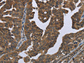 The image on the left is immunohistochemistry of paraffin-embedded Human ovarian cancer tissue using CSB-PA040905(GYS2 Antibody) at dilution 1/50, on the right is treated with fusion protein. (Original magnification: ×200)
