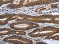 The image on the left is immunohistochemistry of paraffin-embedded Human colon cancer tissue using CSB-PA041073(PDGFA Antibody) at dilution 1/70, on the right is treated with synthetic peptide. (Original magnification: ×200)