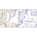 Immunohistochemical analysis of paraffin-embedded human lung carcinoma tissue using Prostate Apoptosis Response Protein-4 antibody.