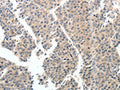 The image on the left is immunohistochemistry of paraffin-embedded Human liver cancer tissue using CSB-PA041300(TEK Antibody) at dilution 1/40, on the right is treated with synthetic peptide. (Original magnification: ×200)
