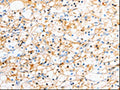 The image on the left is immunohistochemistry of paraffin-embedded Human renal cancer tissue using CSB-PA041819(TTR Antibody) at dilution 1/50, on the right is treated with fusion protein. (Original magnification: ×200)