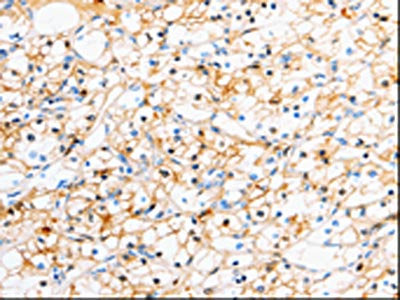 The image on the left is immunohistochemistry of paraffin-embedded Human renal cancer tissue using CSB-PA041819(TTR Antibody) at dilution 1/50, on the right is treated with fusion protein. (Original magnification: ×200)