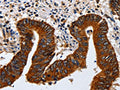 The image on the left is immunohistochemistry of paraffin-embedded Human colon cancer tissue using CSB-PA041845(KRT23 Antibody) at dilution 1/20, on the right is treated with fusion protein. (Original magnification: ×200)
