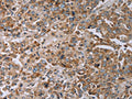 The image on the left is immunohistochemistry of paraffin-embedded Human liver cancer tissue using CSB-PA042633(TNPO1 Antibody) at dilution 1/20, on the right is treated with synthetic peptide. (Original magnification: ×200)
