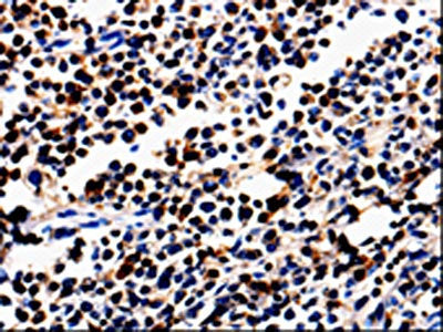 The image is immunohistochemistry of paraffin-embedded Human colon cancer tissue using CSB-PA043268(ALOX5 Antibody) at dilution 1/50. (Original magnification: ×200)