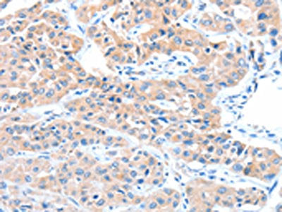 The image on the left is immunohistochemistry of paraffin-embedded Human lung cancer tissue using CSB-PA043425(ADAM32 Antibody) at dilution 1/15, on the right is treated with fusion protein. (Original magnification: ×200)