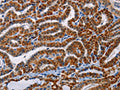 The image on the left is immunohistochemistry of paraffin-embedded Human thyroid cancer tissue using CSB-PA043528(AGPS Antibody) at dilution 1/25, on the right is treated with fusion protein. (Original magnification: ×200)