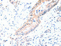 The image on the left is immunohistochemistry of paraffin-embedded Human colon cancer tissue using CSB-PA043583(ACAD10 Antibody) at dilution 1/15, on the right is treated with fusion protein. (Original magnification: ×200)