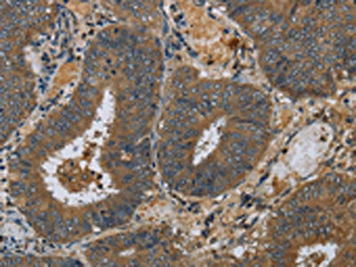The image on the left is immunohistochemistry of paraffin-embedded Human colon cancer tissue using CSB-PA043641(PAEP Antibody) at dilution 1/60, on the right is treated with fusion protein. (Original magnification: ×200)