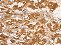 The image on the left is immunohistochemistry of paraffin-embedded Human thyroid cancer tissue using CSB-PA043712(CPB1 Antibody) at dilution 1/50, on the right is treated with fusion protein. (Original magnification: ×200)