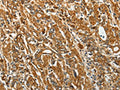 The image on the left is immunohistochemistry of paraffin-embedded Human gastic cancer tissue using CSB-PA043719(RPLP0 Antibody) at dilution 1/40, on the right is treated with fusion protein. (Original magnification: ×200)