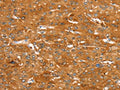 The image on the left is immunohistochemistry of paraffin-embedded Human liver cancer tissue using CSB-PA043862(ABCC9 Antibody) at dilution 1/50, on the right is treated with synthetic peptide. (Original magnification: ×200)