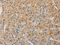 The image on the left is immunohistochemistry of paraffin-embedded Human liver cancer tissue using CSB-PA043937(NFE2L1 Antibody) at dilution 1/30, on the right is treated with fusion protein. (Original magnification: ×200)