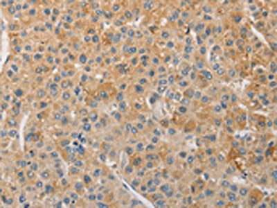 The image on the left is immunohistochemistry of paraffin-embedded Human liver cancer tissue using CSB-PA043937(NFE2L1 Antibody) at dilution 1/30, on the right is treated with fusion protein. (Original magnification: ×200)