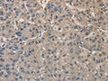 The image on the left is immunohistochemistry of paraffin-embedded Human liver cancer tissue using CSB-PA044503(DPYSL3 Antibody) at dilution 1/20, on the right is treated with fusion protein. (Original magnification: ×200)