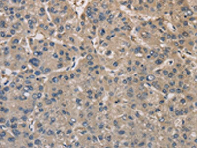 The image on the left is immunohistochemistry of paraffin-embedded Human liver cancer tissue using CSB-PA044503(DPYSL3 Antibody) at dilution 1/20, on the right is treated with fusion protein. (Original magnification: ×200)